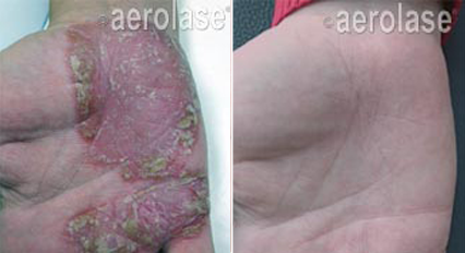 Psoriasis1 - Pair