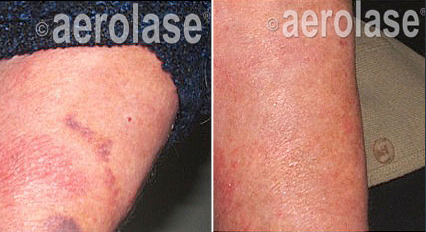 Psoriasis2 - Pair