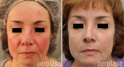 Rosacea2 - Pair