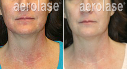 Rosacea3 - Pair