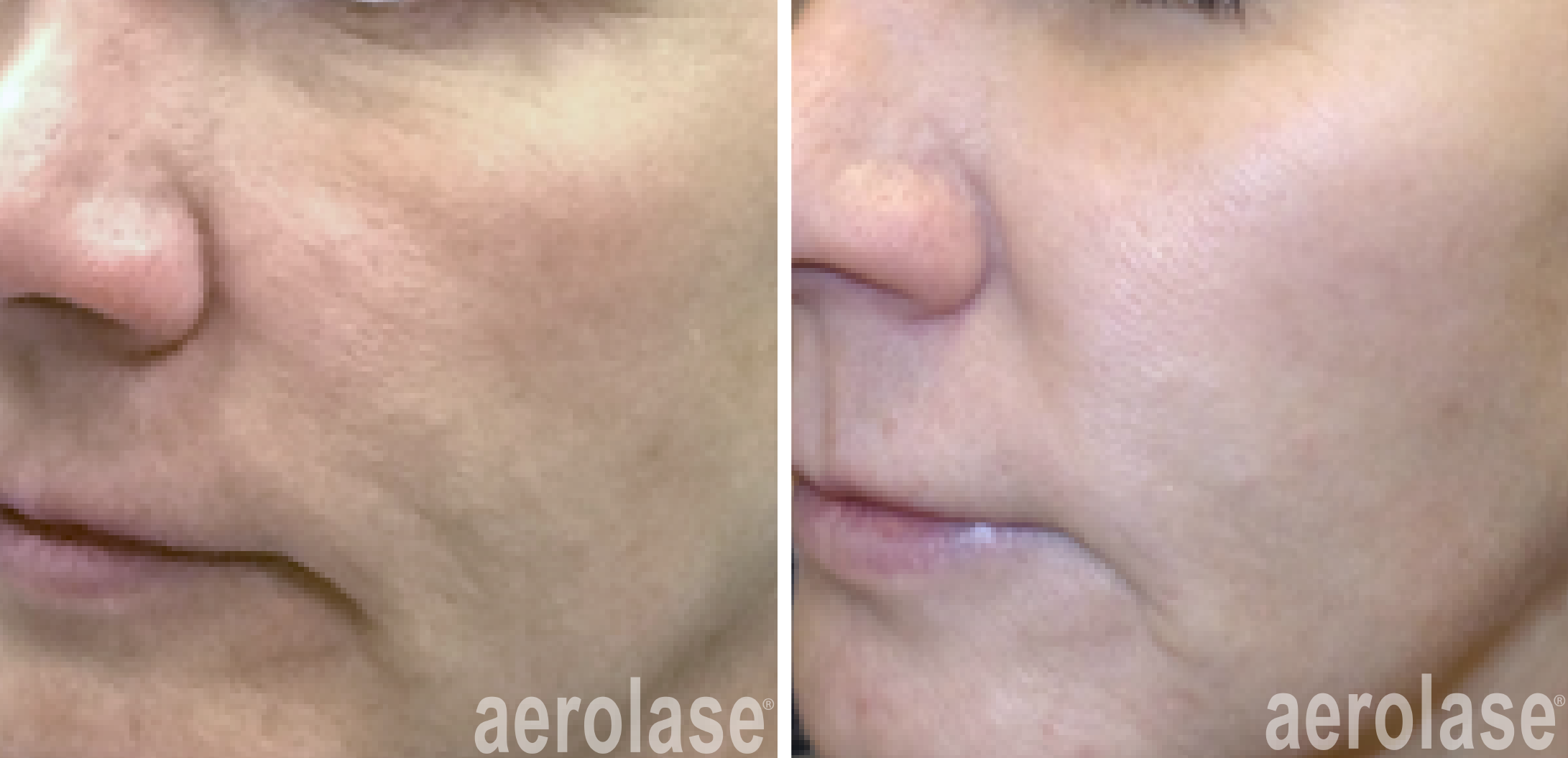 aerolase-skin-rejuvenation-before-after-kevin-pinski-4-treatments